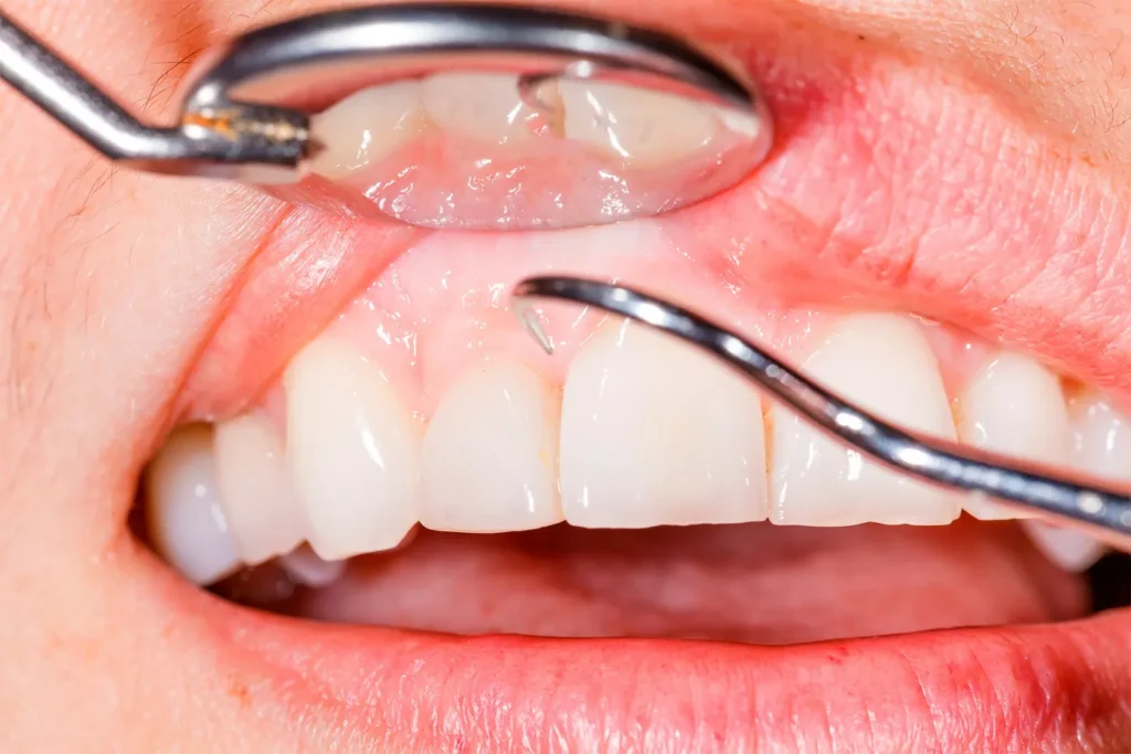 Close-up of teeth during a dental exam with a metal instrument lifting the lip for inspection