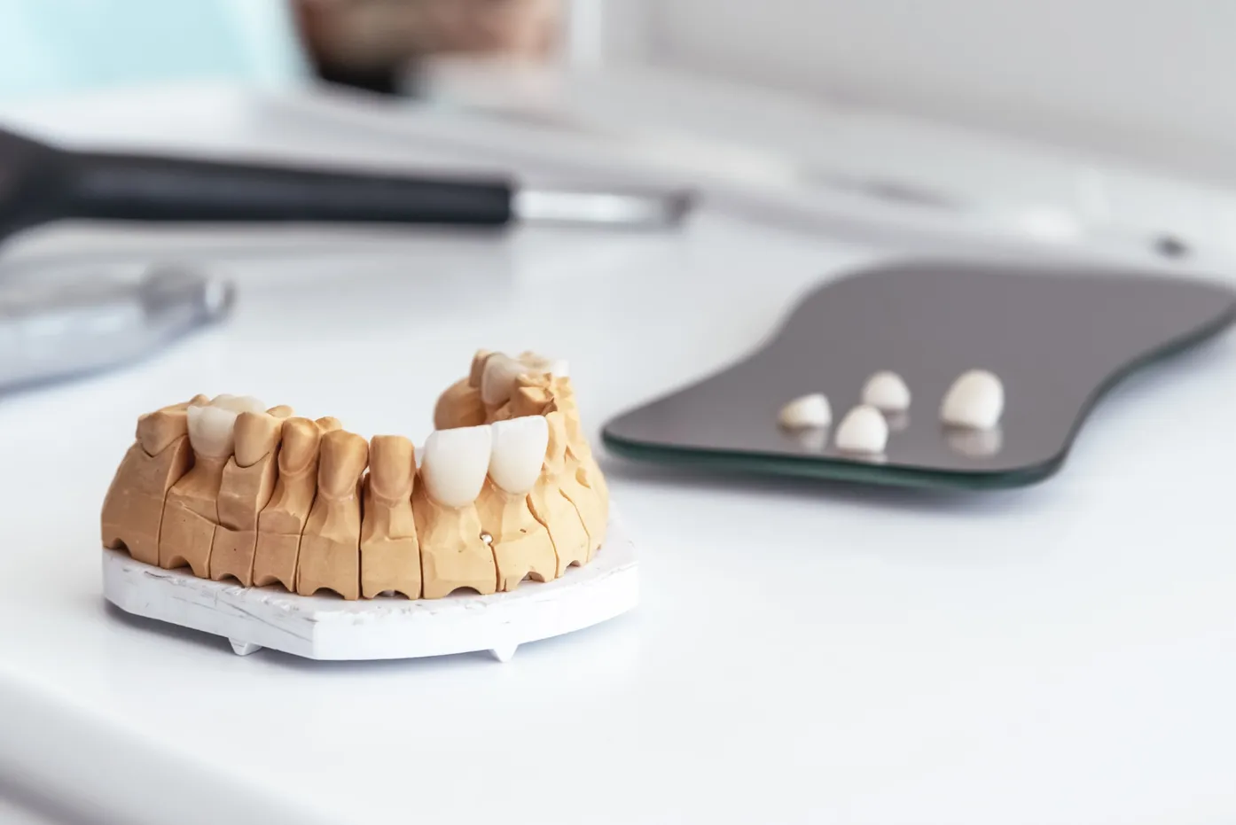 Dental model with prepared teeth and restorations displayed on a countertop in a clinical setting