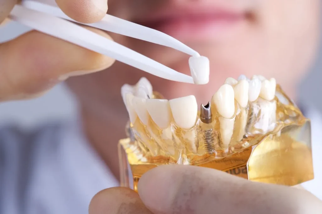Close-up of a dental veneer or crown being placed on a tooth model with tweezers during a restorative dentistry demonstration